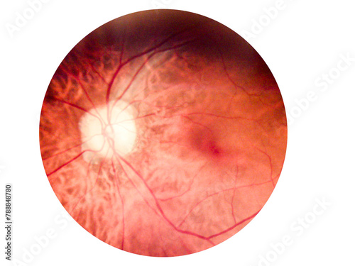 Patient elderly with retina of diabetes.Human eye anatomy taking images with Mydriatic Retinal cameras. photo