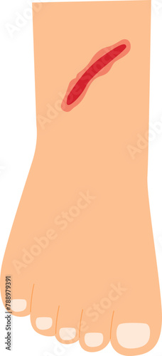 woBleeding wound on palm