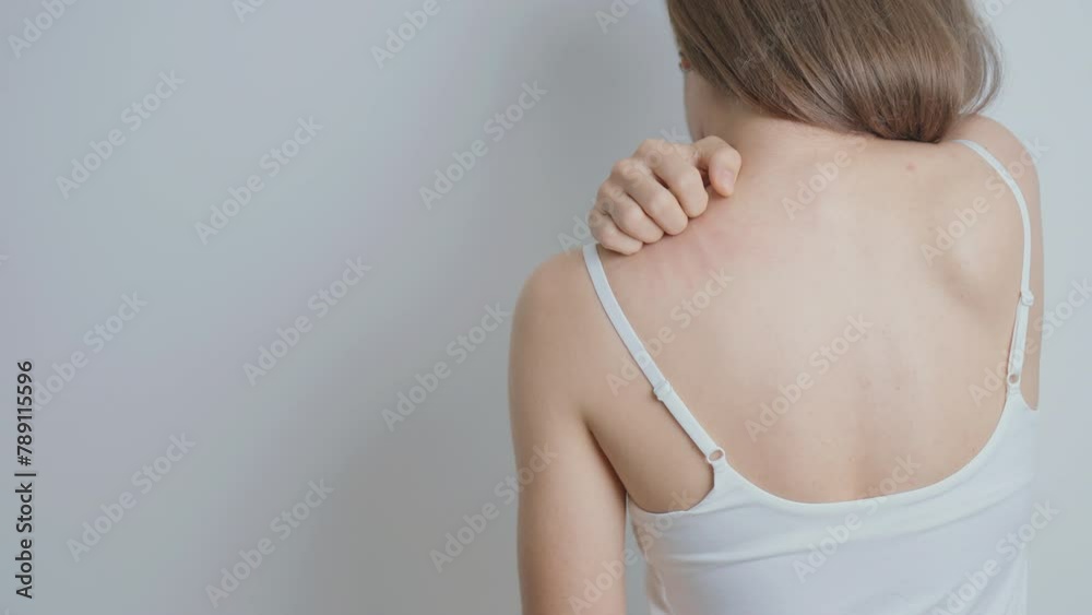 woman itching and scratching itchy back. Sensitive Skin Allergic reaction to insect bite, food, drug dermatitis. Dermatology, Leprosy, Systemic lupus erythematosus, Allergy symptoms and rash Eczema woman itching and scratching itchy back. Sensitive Skin Allergic reaction to insect bite, food, drug dermatitis. Dermatology, Leprosy, Systemic lupus erythematosus, Allergy symptoms and rash Eczema