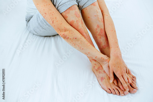 A women legs, which are in the phase of exacerbation of a skin disease.