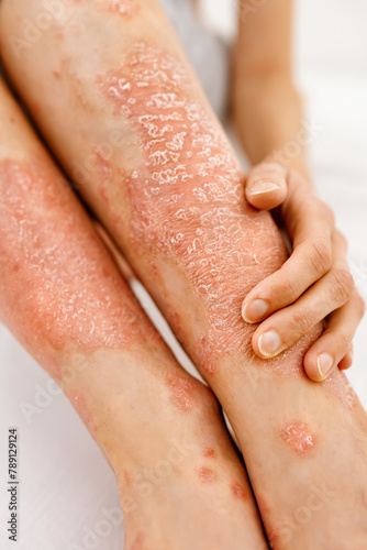Rash, red spots, itching and peeling of the skin. An allergic reaction on human skin.