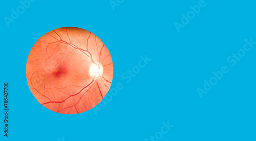 Patient elderly with retina of diabetes.Human eye anatomy taking images with Mydriatic Retinal cameras.A prepapillary vascular loop on the retina, as observed during ophthalmoscopy.