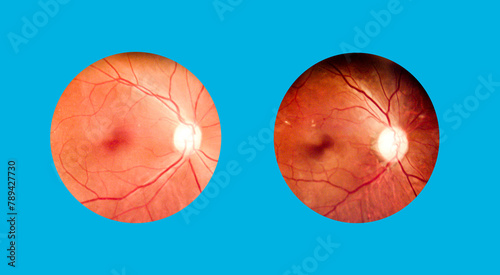 Patient elderly with retina of diabetes.Human eye anatomy taking images with Mydriatic Retinal cameras.A prepapillary vascular loop on the retina, as observed during ophthalmoscopy. © Mohwet