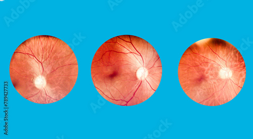 Patient elderly with retina of diabetes.Human eye anatomy taking images with Mydriatic Retinal cameras.A prepapillary vascular loop on the retina, as observed during ophthalmoscopy. © Mohwet