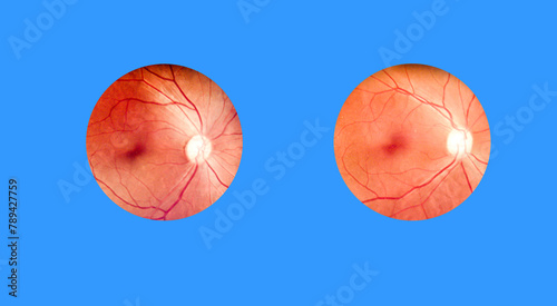 Patient elderly with retina of diabetes.Human eye anatomy taking images with Mydriatic Retinal cameras.A prepapillary vascular loop on the retina, as observed during ophthalmoscopy. photo