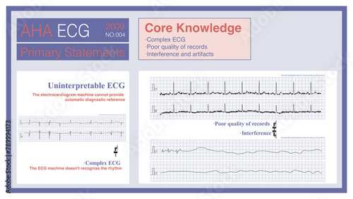 When the ECG is too complex, the recording quality is poor, or it is impossible to interpret what is causing the loss of the ECG, the ECG machine will not be able to provide a diagnostic reference.
 photo