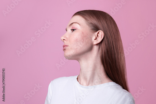 beautiful red-haired young woman with sensitive rosacea redness acne problem skin, teenage girl profile portrait close up isolated on pink background