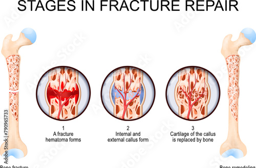 Stages in fracture repair. From Bone fracture to Bone remodeling