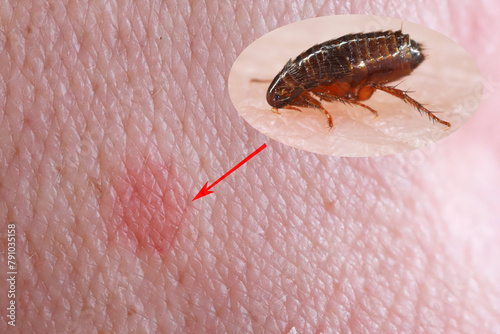 The flea feeds on human skin. Painful flea bite. photo
