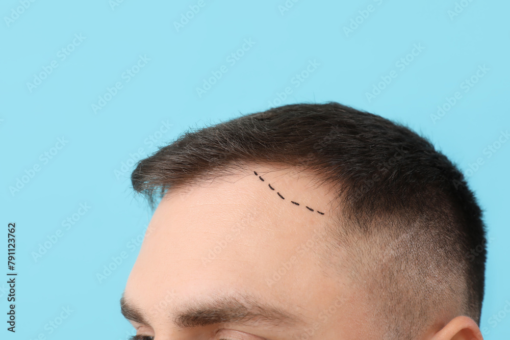 Young man with hair loss problem and marks on his forehead against blue background, closeup