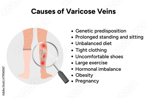 Causes of varicose veins