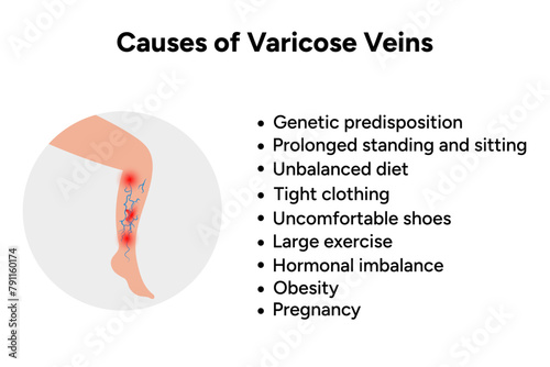 Causes of varicose veins