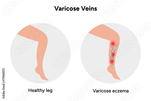 Healthy and Varicose veins, varicose eczema 