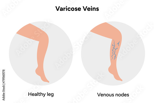 Healthy and Varicose veins, venous nodes 