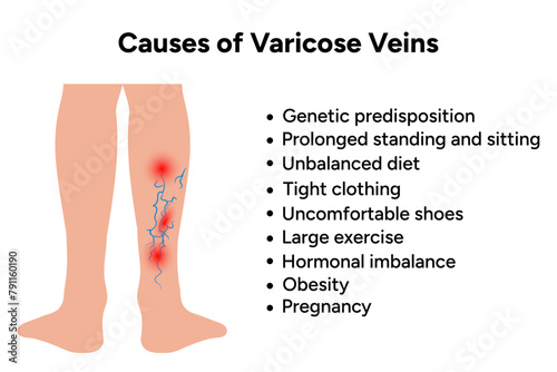 Causes of varicose veins