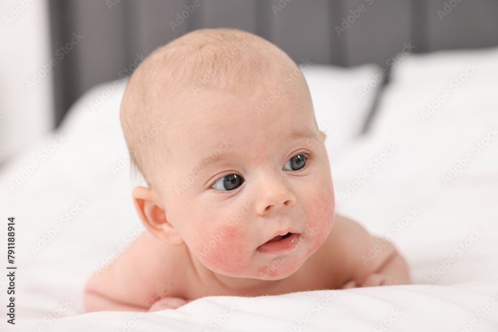 Cute little baby with allergic redness on cheeks lying on bed at home Cute little baby with allergic redness on cheeks lying on bed at home