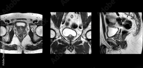 MRI of the prostate gland reveals Focal abnormal SI lesion at left PZpl at apex as described; PI-RADS category 4, clinically