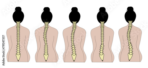 Types of scoliosis, spine curvature deformity, human spinal backbone anatomy, orthopaedic medical. Educational vector design