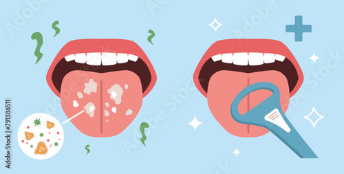 Bad smell removal. Cleaning tongue, halitosis prevention, oral hygiene, plaque removal process, fighting bad breath, bacteria, health care cartoon flat isolated nowaday vector concept