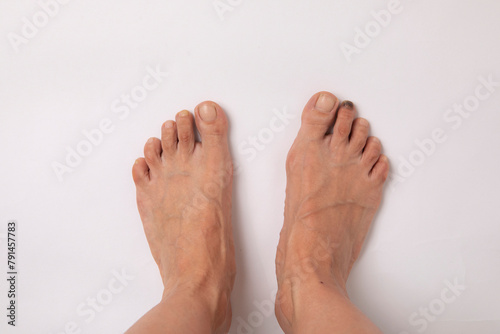 people, person, model health, healthy, healthcare, care, medical people, person, model health, healthy, healthcare, care, closeup, close cutout, cut out foot  finger foot fungus foot health