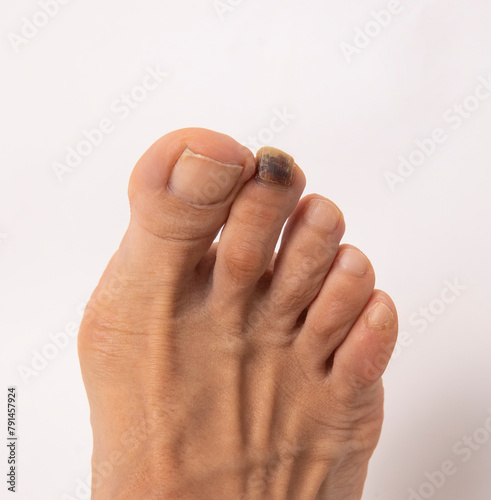 people, person, model health, healthy, healthcare, care, medical people, person, model health, healthy, healthcare, care, closeup, close cutout, cut out foot  finger foot fungus foot health