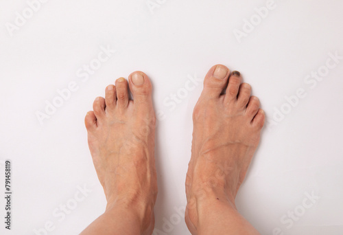 people, person, model health, healthy, healthcare, care, medical people, person, model health, healthy, healthcare, care, closeup, close cutout, cut out foot  finger foot fungus foot health © aslhan