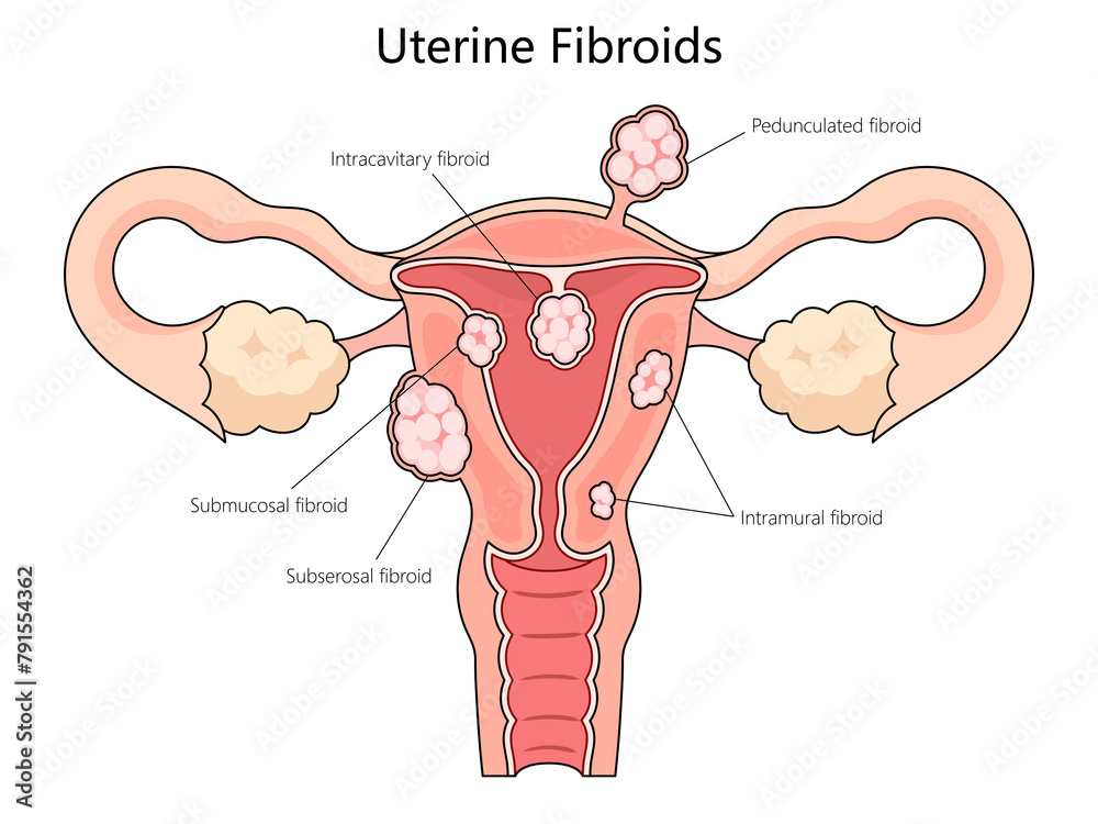 Human various types of uterine fibroids, including submucosal ...