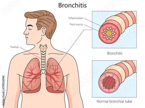 Healthy and bronchitis affected bronchial tubes, with a focus on inflammation and mucus buildup structure diagram hand drawn schematic raster illustration. Medical science educational illustration