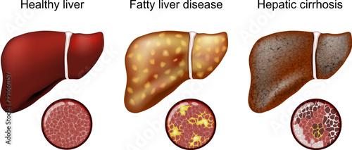 Fatty liver disease. Hepatic cirrhosis photo