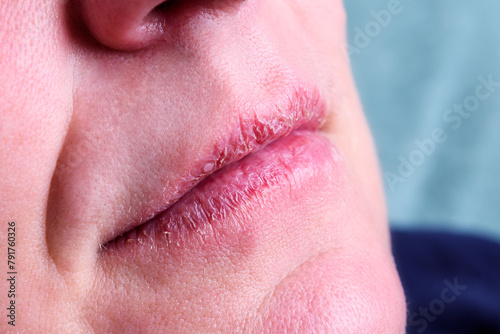 Chapped, or cracked, dry lips that have lost moisture.