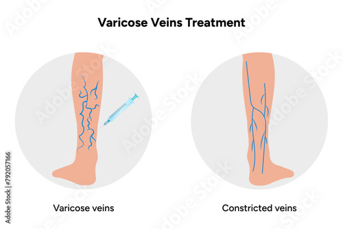 Varicose veins treatment,  Sclerotherapy