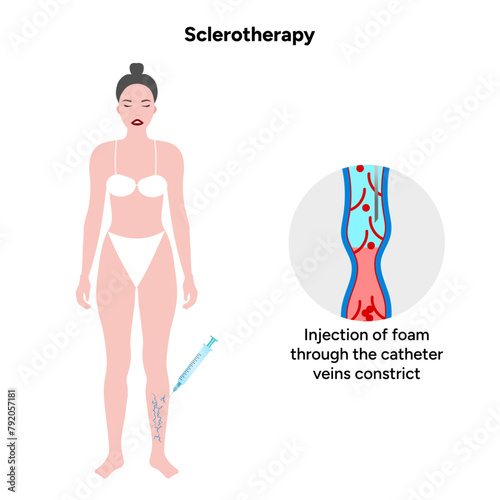 Normal and Varicose vein treatment, Sclerotherapy 