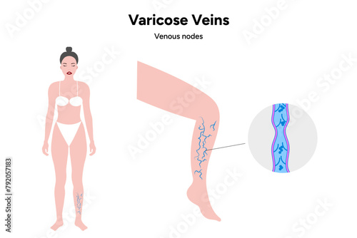 Varicose veins, venous nodes