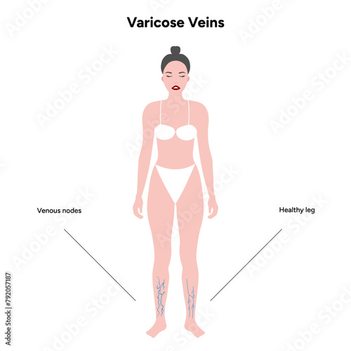 Varicose veins and healthy leg