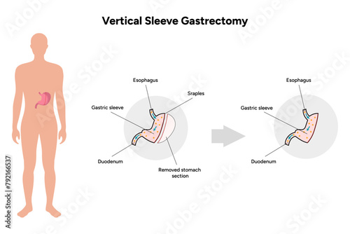 Vertical Sleeve Gastrectomy  photo