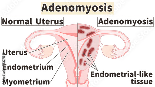 Adenomyosis labeled diagram; Normal and adenomyotic uterus PNG
