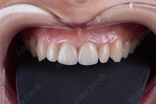 Macro photography of teeth with veneers