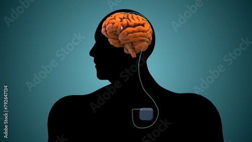 The medical notion of deep brain stimulation