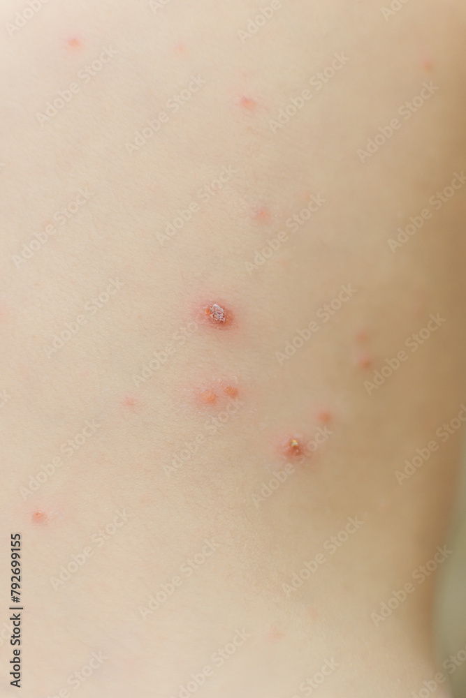chickenpox on the body of a small child. skin disease. a childhood infection. treatment of chickenpox at home chickenpox on the body of a small child. skin disease. a childhood infection. treatment of chickenpox at home