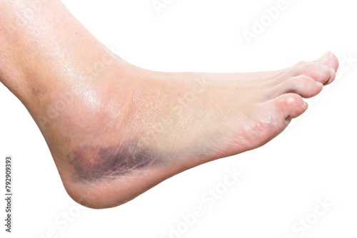 close up of foot with injury, sprain, strain, inflammation, bruise, kinesiology photo