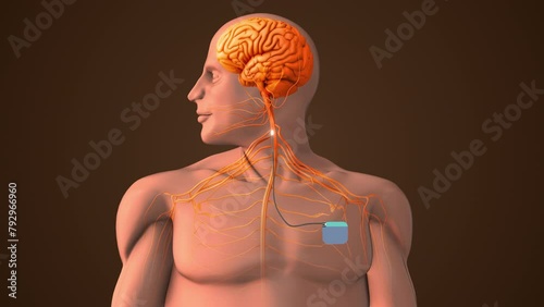 Medical treatment with Vigus Nerve Stimulation