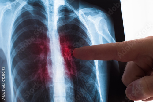Lung radiography concept. Radiology doctor examining at chest x ray film of patient Lung Cancer or Pneumonia. Virus and bacteria infected the Human lungs. Patient with Lung Cancer or Pneumonia