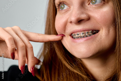 Portrait of a young smiling woman with braces to correct her bite photo