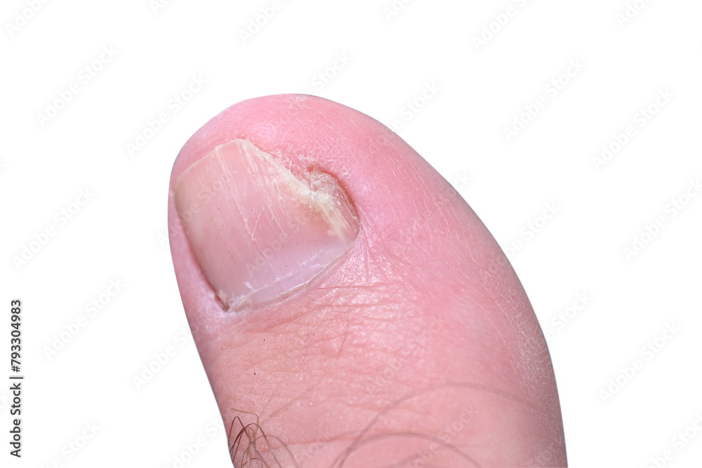 mycosis Fungal infection of the big toe nails. Fungal infection of toenails with ringworm onychomycosis, heat dry skin infection disease result mycosis Fungal infection of the big toe nails. Fungal infection of toenails with ringworm onychomycosis, heat dry skin infection disease result