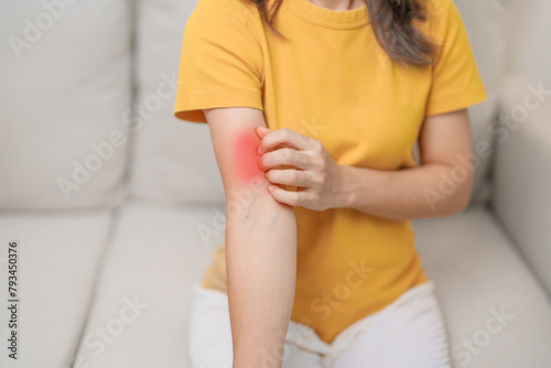 woman itching and scratching itchy arm. Sensitive Skin Allergic reaction to insect bite, food, drug dermatitis. Dermatology, Leprosy day, Systemic lupus erythematosus, Allergy symptoms and rash Eczema