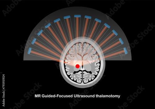 MR-guided focused ultrasound thalamotomy for the treatment of tremor.