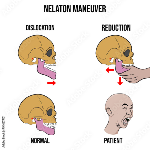 Nelaton maneuver, conventional reduction technique in patient.
