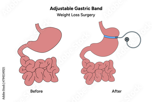 Adjustable Gastric Band, Bariatric surgery procedures