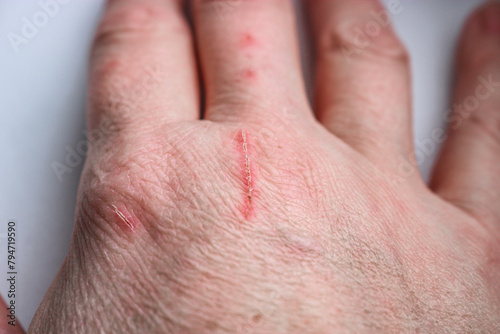 Close-up of a pet owner's scratched hand. Selective Focus © ss404045