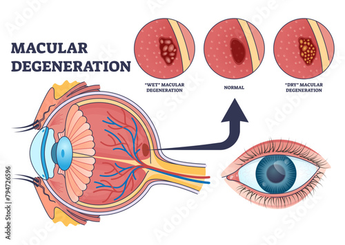 Macular degeneration as eye illness and eyesight problem outline diagram, transparent background. Labeled educational scheme with central vision loss disease with wet or dry types illustration. photo